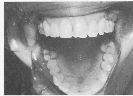 5 Acrylic-over- old splint over endosseous implant shaft on maxilla