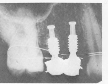 6 Clinical view of upper endosseous implant restoration