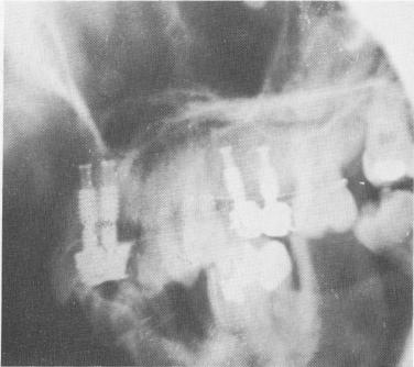 1 Lateral plate roentgenogram illustrating endosseous implants