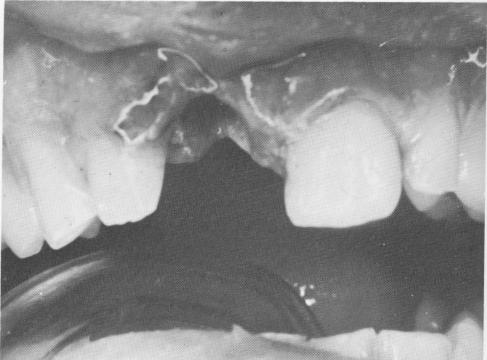 2 Upper tooth curetted to remove granulation tissue, implant relevance