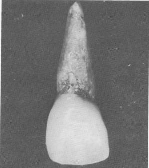 3 Heat-cured acrylic tooth fabricated