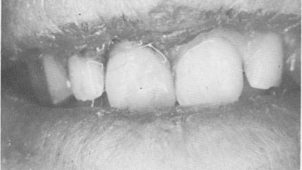 4 Custom made tooth in maxillary socket, splinted to adjacent teeth