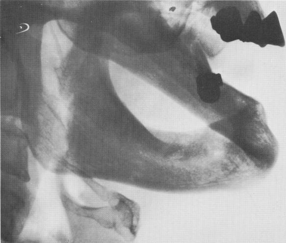 1 Edentulous mandible with adequate alveolar bone, implant consideration