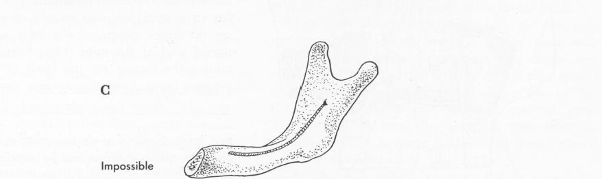2 Classification of mandible for endosseous implantation