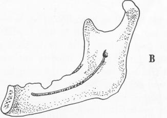 3 Indication for subperiosteal implantation in mandible