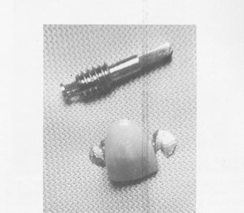 1 Labial view of endosseous implant restoration