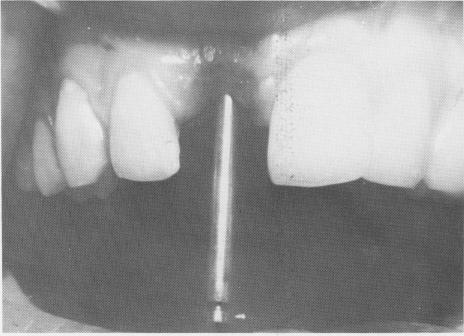 2 Spear-point entering bur used for upper endosseous implantation