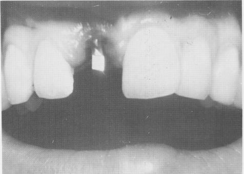 3 Upper vent-plant endosseous implant is threaded into position