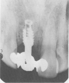 2 Postoperative xray of single tooth upper endosseous implant shaft