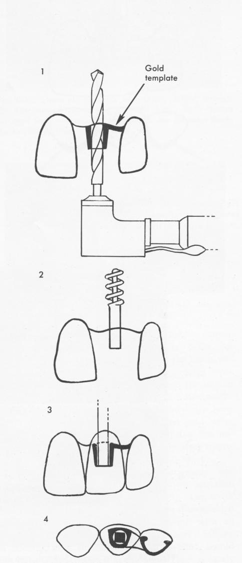 3 Single tooth endosseous implant shaft stabilized by neighboring tooth 
