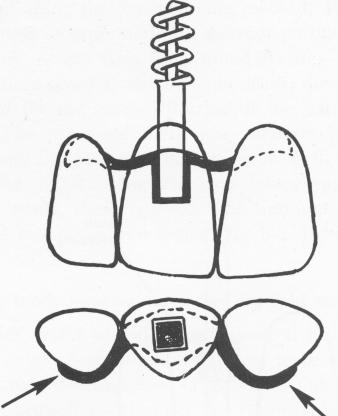 1 Single tooth upper spiral-post endosseous implant, lingual arm clasp