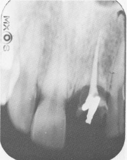 3 Remaining portion of upper reimplanted tooth removed, implant relevance