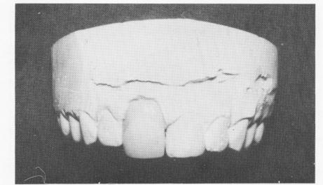 1 All-acrylic jacket over gold thimble crown on upper endosseous implant