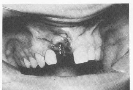 2 Three endosseous pins implanted through fibromucosa and maxillary bone