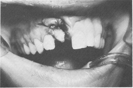 3 Protruding upper endosseous pin implants fused with acrylic core