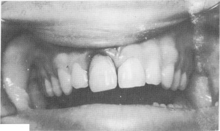 4 Endosseous upper pin implant crown cemented to acrylic core with resin