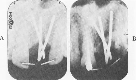 1 Inflammation, hypertrophy above endosseous pin implant acrylic crown