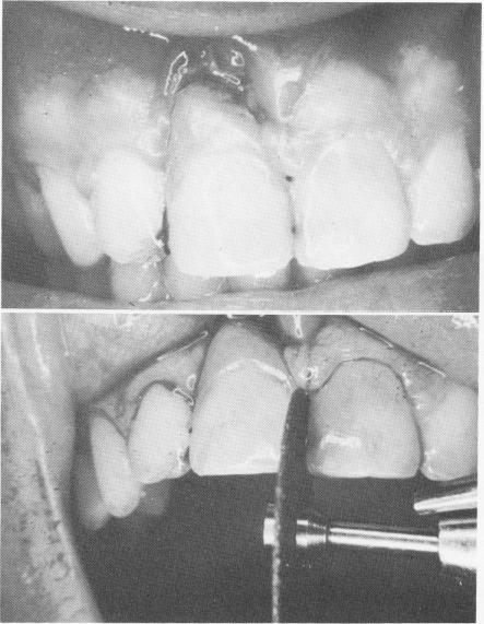 2 Disc away A-splint wire at proximal side of pin implant restoration