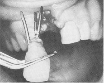 3 Removal of maxillary endosseous tripodial implant