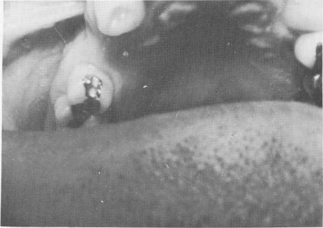 1 Maxillary inlay tooth preparation, single tooth implant relevance