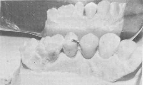 2 Acrylic over gold thimble crown, attached inlay, implant relevance