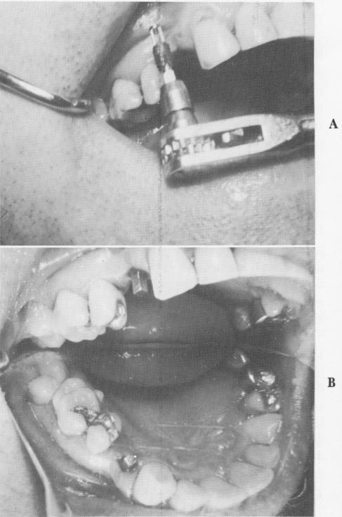 3 Self tapping vent plant endosseous implant in prolongator, in maxilla