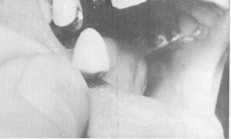 4 Vent plant endosseous upper implant post should not interfere occlusion