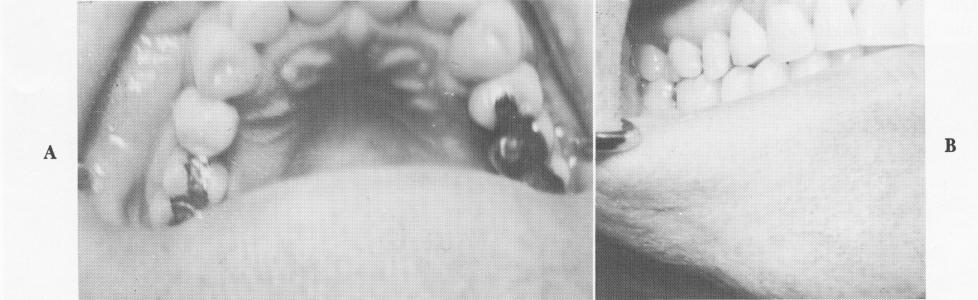 1 Acrylic crown cemented over upper endosseous vent plant implant shaft