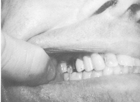 2 Upper vent plant crown inlay attachment cemented in prepared seat