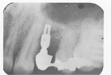 3 Xray of case of stabilized upper endosseous implant with inlay