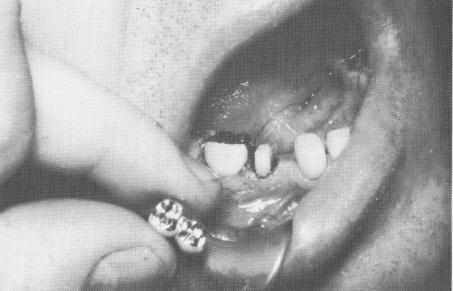 1 Splint fitted into position prior to single tooth implant insertion