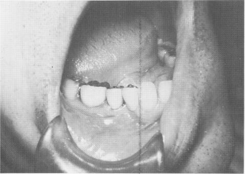 2 Lower single tooth implant site transfer to tissue with pencil tracing