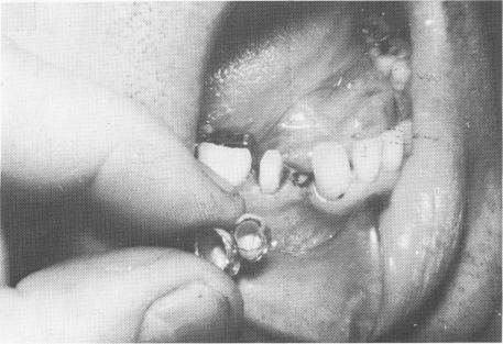 3 Lower tooth in symbiosis with vent-plant implant for two-unit splint