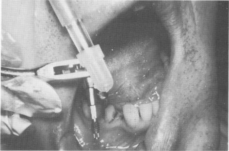 4 Mandibular vent-plant implant attached to the ratchet