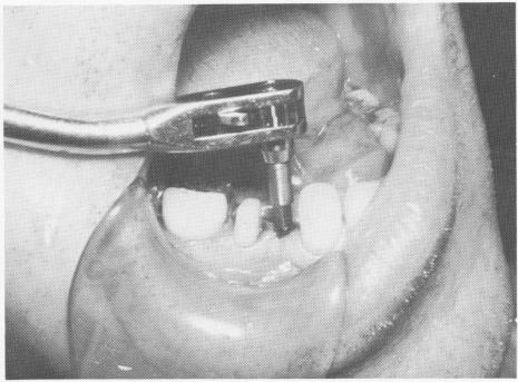 1 Lower vent plant endosseous implant screwed into position