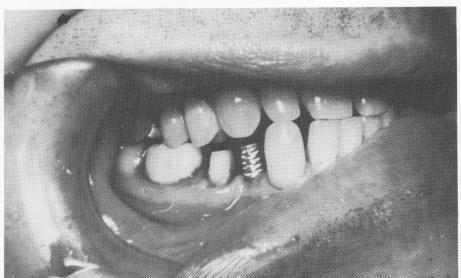 2 Lower vent-plant endosseous implant is seen in its proper relationship