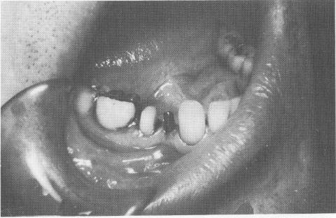 3 Vent plant implant shaft length allows gold, porcelain in restoration