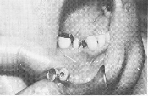 4 Interchangeable gold coping placed over vent plant implant shaft