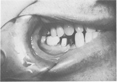 5 Gold coping picked up inside vent plant implant crown with acrylic