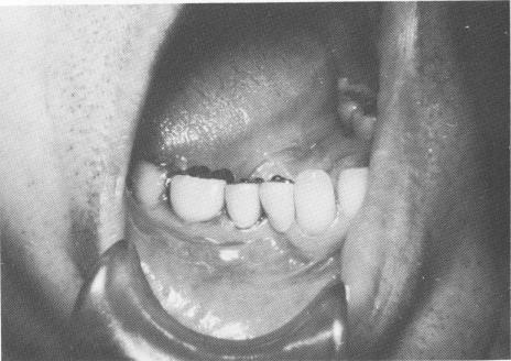 6 Two-unit lower vent plant implant splint cemented in position