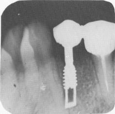 1 Radiograph of single tooth vent plant endosseous implantation