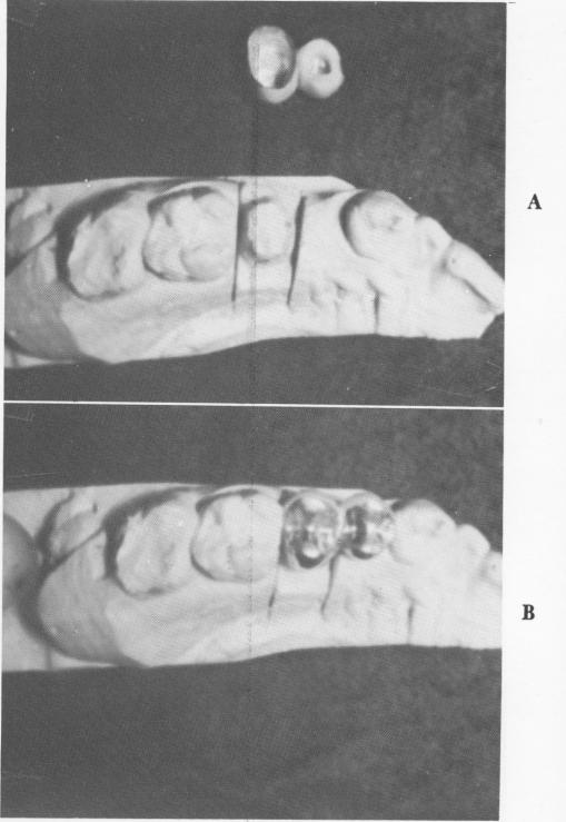 2 Missing maxillary first premolar, vent plant implant consideration