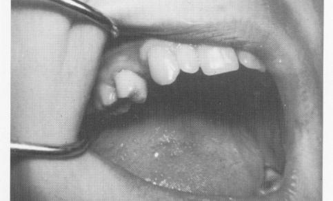 3 Two-unit splint for vent plant single tooth implant on master model