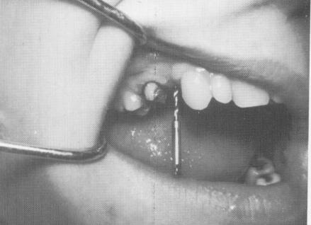 4 Twist drill to trephine bone for single tooth vent plant implantation