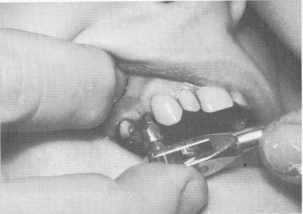 2 Narrow ridge endosseous implant ratcheted into narrow maxillary bone