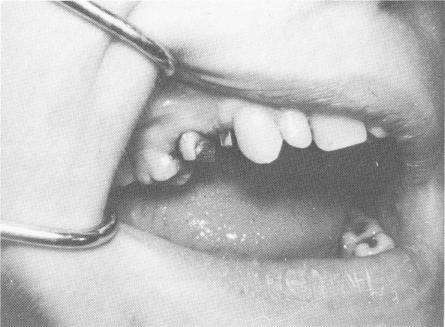 3 Upper narrow ridge endosseous implant shaft extends from fibromucosa