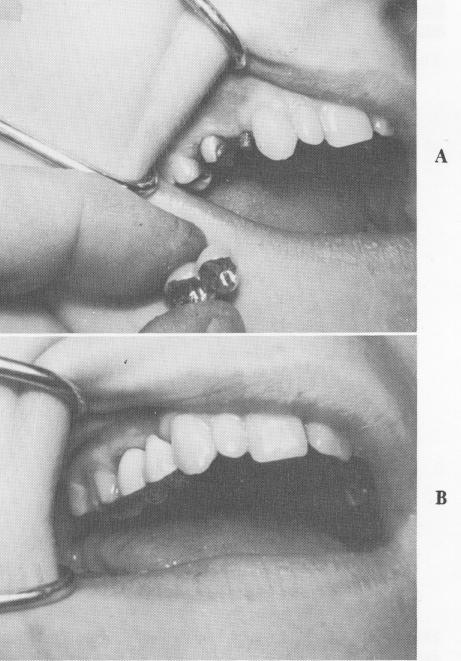 4 Narrow ridge endosseous implant splint is fitted into position