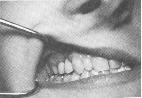 1 Upper narrow ridge endosseous implant splint carefully balanced