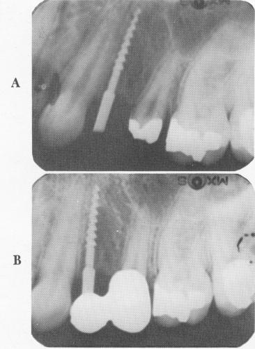 2 Xray of upper narrow ridge endosseous implant at desired bone depth