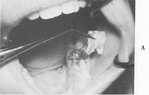 3 Prosthesis cemented on narrow ridge endosseous implant, tooth abutment